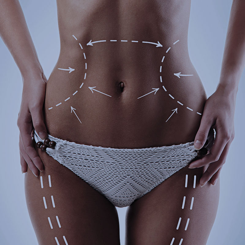 lipoabdominoplastia